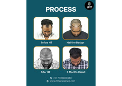 best hair transplant clinic in Jaipur